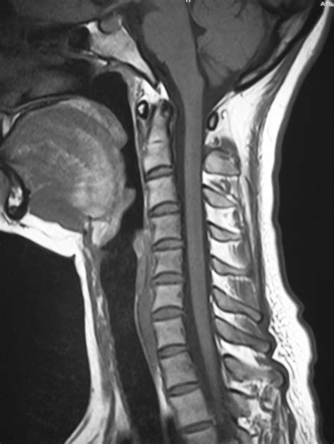 Cervical Spine Fracture Complications Healthfully