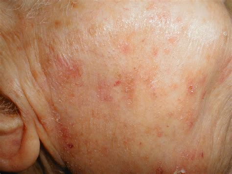 Medical Pictures Info Actinic Keratosis Picture
