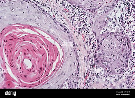 Squamous Cell Carcinoma Stock Photo Alamy