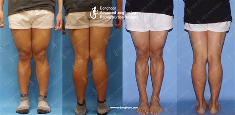 Knock Knees Correction Limb Lengthening And Complex Reconstruction