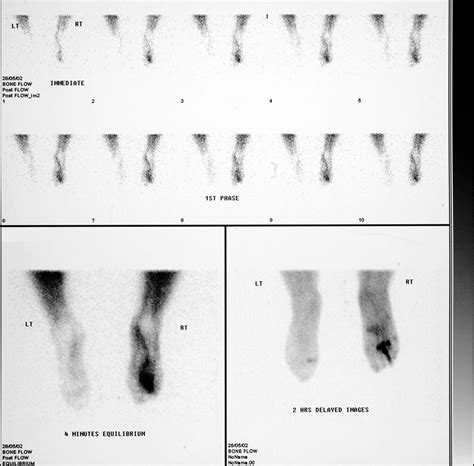 3 Phase Bone Scan Interpretation Radiology Notes