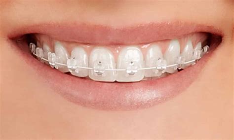 Clear Ceramic Braces Sks Orthodontics Proudly Serving Fayetteville North Syracuse Fulton