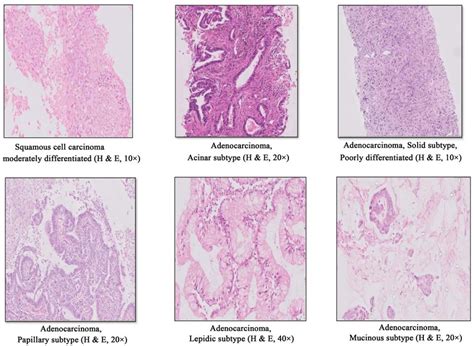 Representative H And E Images Of Squamous Cell Carcinoma And