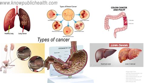 Types Of Cancer Know Public Health