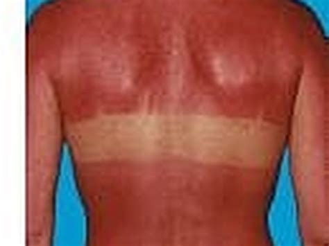 Before you do anything else, recommends dermatologist francesca fusco, pop an aspirin or tylenol to immediately reduce. How to Treat A Sunburn with Noxzema | LEAFtv