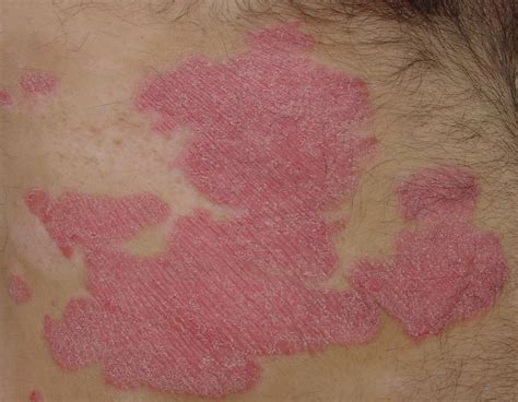 Psoriasis Awareness Month Treatment Methods To Prevent The Disease