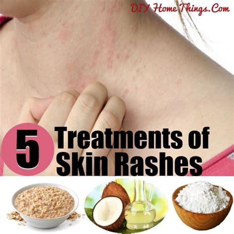 Moreover, its acetic acid content. Top 5 Home Treatments of Skin Rashes | DIY Home Things