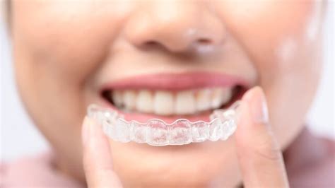 How Much To Remove Braces Without Insurance Detailed Guide