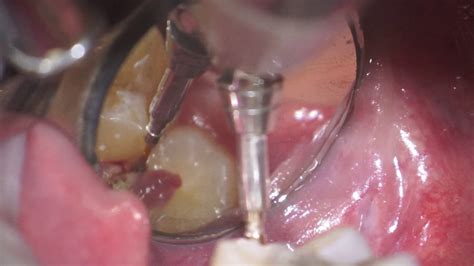 Operculectomy Of Mx 3dr Molar Youtube