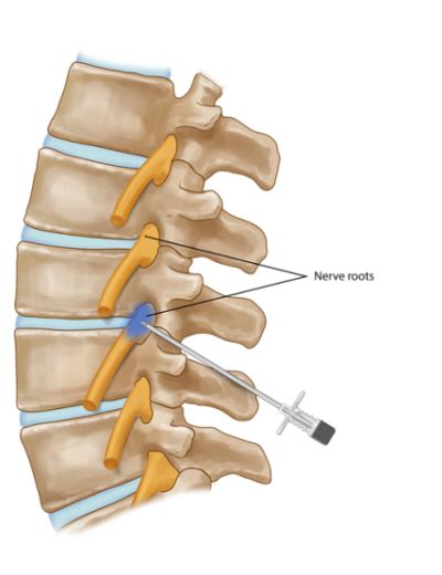 Selective Nerve Root Block Legacy Spine And Neurological Specialists