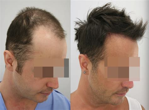 Fascination About Hair Transplant Turkey Prices 2022 Estevien Clinic