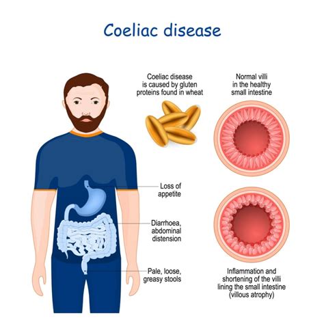 What Is Coeliac Disease The Ibs And Gut Health Clinic