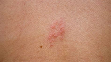 6 Questions To Ask Your Healthcare Provider About Shingles Skin