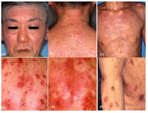 Jcm Free Full Text Clinical Characteristics Treatments And Prognosis Of Atopic Eczema In