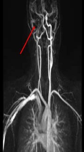 Agenesis Of The Right Internal Carotid Artery Mri Angiography Of Download Scientific Diagram