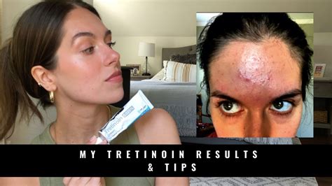 My Tretinoin Results And Tips Rudi Berry Youtube
