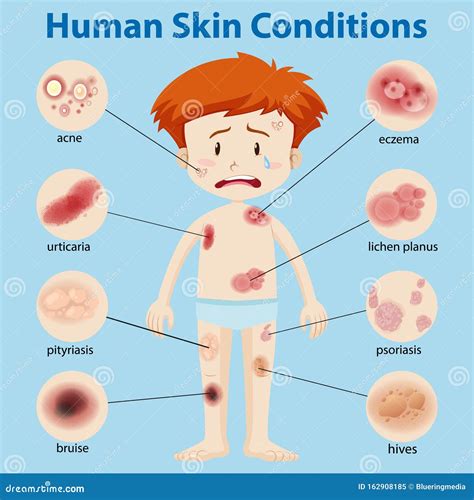 Skin Conditions Having An External Resemblance To Vitiligo Vector