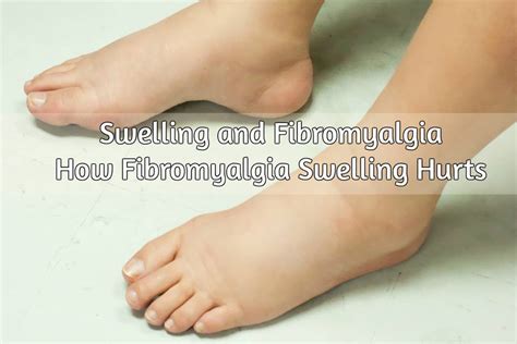 Swelling And Fibromyalgia How Fibromyalgia Swelling Hurts Women With