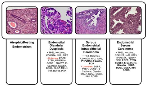 Pathophysiology Of Endometrial Cancer