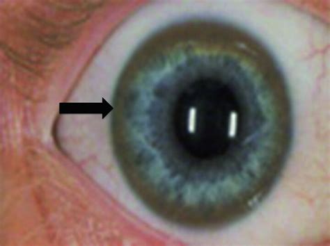 Aneis De Kayser Fleischer