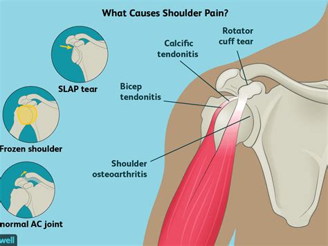 Sechrest, md narrates an animated tutorial on the basic anatomy of the shoulder. Shoulder Muscles Diagram - Muscles Of The Shoulder Joint And Girdle Human Anatomy Kenhub Youtube ...