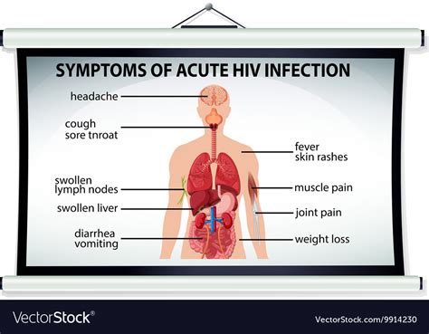 chart showing symptoms of acute hiv infection vector image