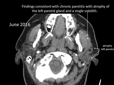 Parotid Duct Stone Ultrasound