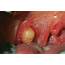 Mucous Retention Cyst Photograph By Dr P Marazzi/science Photo Library
