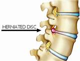 Chiropractic Treatment For Herniated Disc Photos