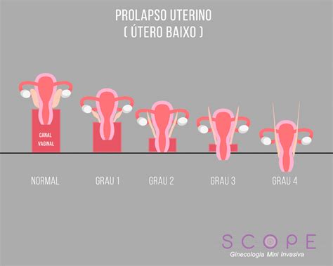 Prolapso uterino conheça causas e tratamentos