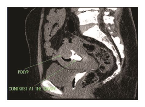Ct Sagittal Reformatted Image Of The Pelvis At The Level Of The Upper