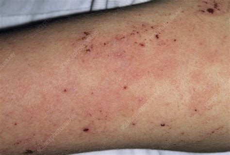 Eczema On An Arm Stock Image M1500234 Science Photo Library