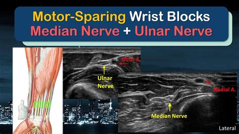 Motor Sparing Median And Ulnar Nerve Blocks At The Wrist A How To
