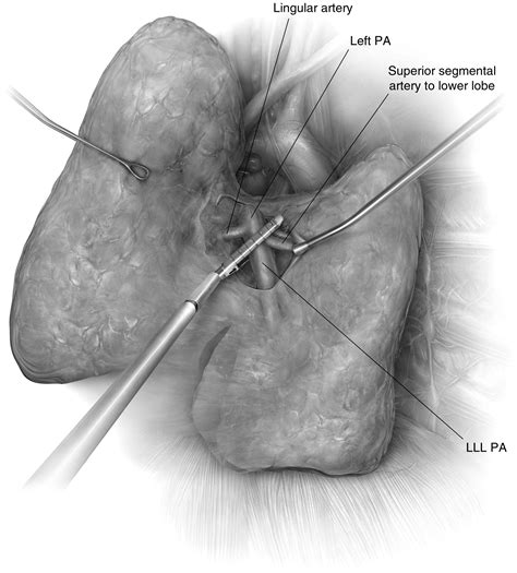 Video Assisted Thoracic Surgery Lobectomy Operative Techniques In Thoracic And Cardiovascular