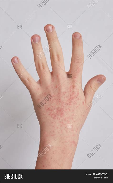 Allergic Reactions On Image And Photo Free Trial Bigstock