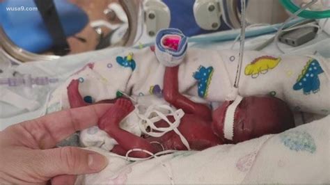 Holy Cross Health Treats Smallest Micro Baby At Nicu On Record