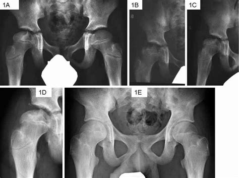 A Avascular Necrosis Of Right Femoral Head In A 12 Year 4 Month Old