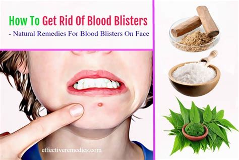Top 17 Ways How To Get Rid Of Blood Blisters On Face And In Mouth
