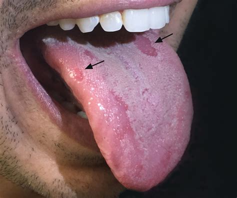 Bumps Under Tongue Std