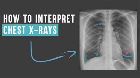 How To Interpret Chest X Rays Digital Doctors Youtube