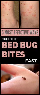 5 Most Effective Ways To Get Rid Of Bed Bug Bites Fast Bed Bug Bites