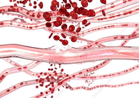 Ruptured Blood Vessels Stock Image P2060315 Science Photo Library