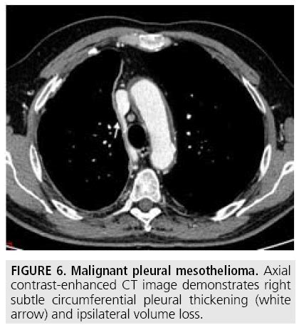 Learn about symptoms, treatment options and prognosis on asbestos.com. Diagnostic imaging and workup of malignant pleural ...