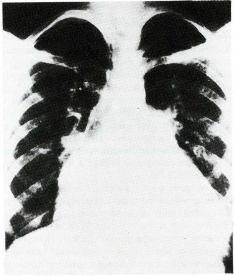 Posteroanterior Chest Radiograph Demonstrating The Enlarged Cardiac