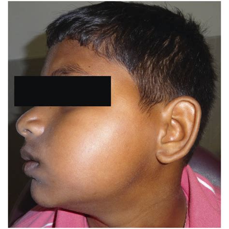 Clinical Photograph Showing Diffuse Swelling On The Left Side Of The