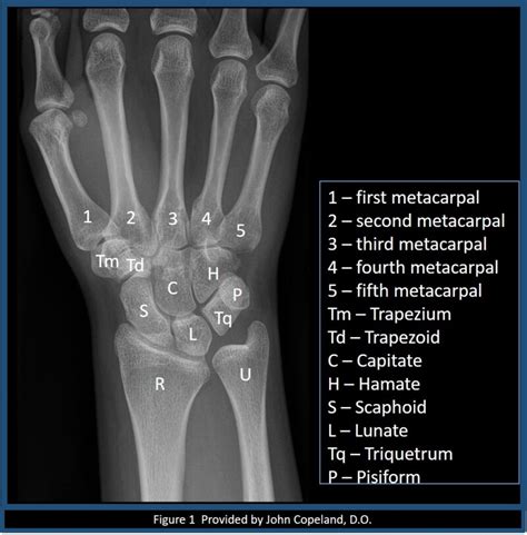 Figure Wrist X Ray With Labeled Osseous Anatomy Contributed By John Copeland Do Statpearls