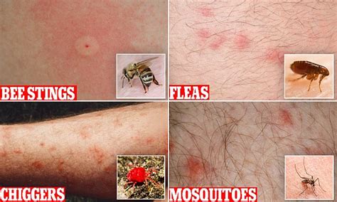Identify Bug Bites Sting