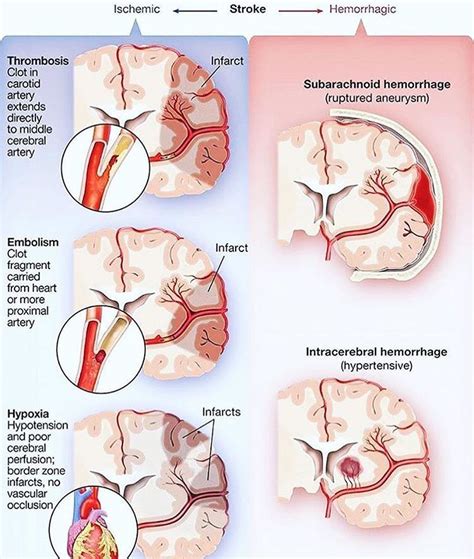 Types Of Intracranial Hematomas Cindy Bou Bruidstaart