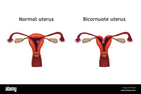 Bicornuate Uterus And Normal Uterus Comparison Illustration A