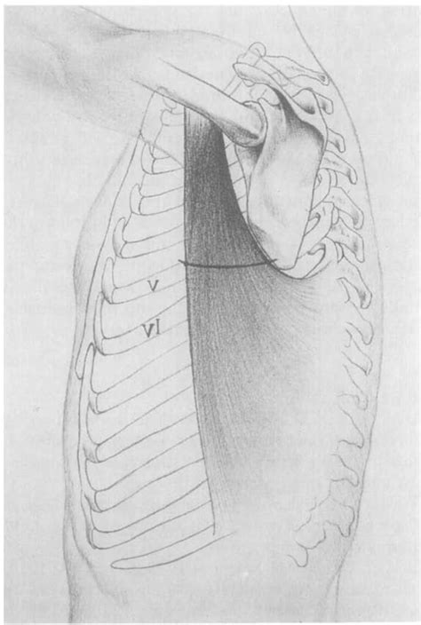 Figure 1 From Reverse Flap Of Distal Latissimus Dorsi For Diaphragm